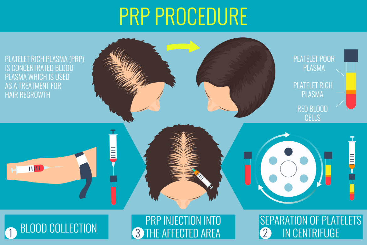 Acell Prp Hair Regrowth Injection Therapy Fallon Hair Restoration
