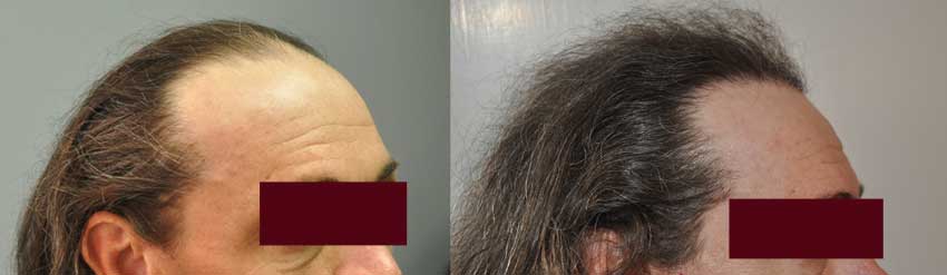 1500_Hair_Grafts_Right_Side