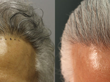 FUE Hairline Restoration