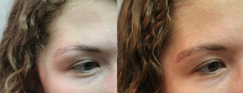 Eyebrow Hair Transplant to Repair Scar - Fallon Hair Restoration