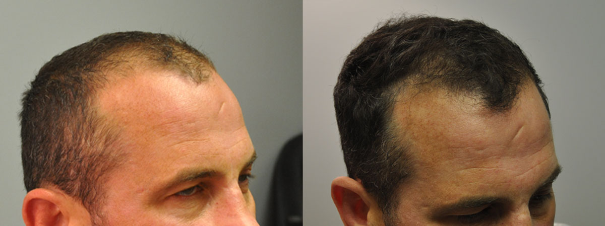Limmer HTC på X: «#TransformationTuesday - This 37 year old male patient  received approximately 1000 grafts transplanted using the FUE method along  with Finasteride and Minoxidil. https://t.co/NcMLnHiukX» / X
