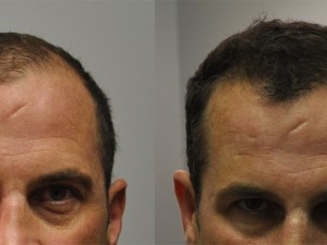 1000 FUE Hair Transplant 4.5 Month Follow Up