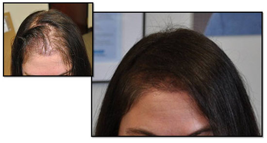 Female Hair Transplant - Portland Or | Fallon Hair Retoration