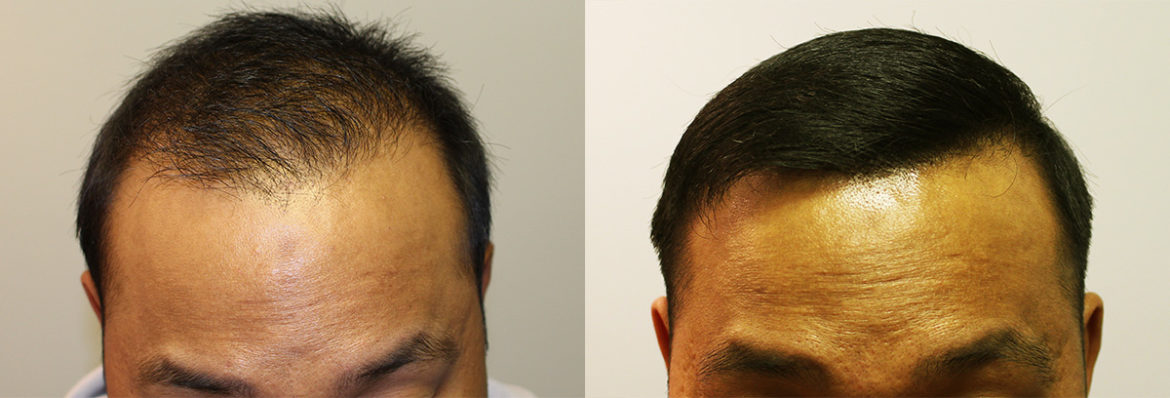 Hair Transplant Case Study - 1677 Grafts - Combination FUT and FUE  Procedure - Fallon Hair Restoration