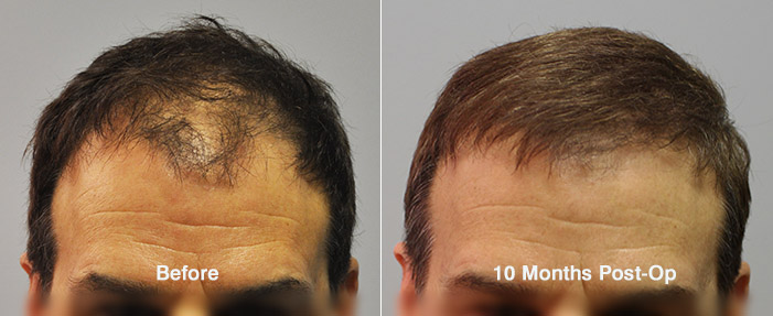 Hair Transplant Case Study - 2100 Grafts - Fallon Hair Restoration