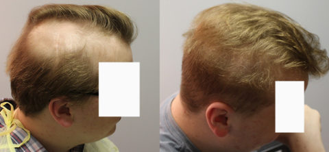 brain tumor Archives - Fallon Hair Restoration