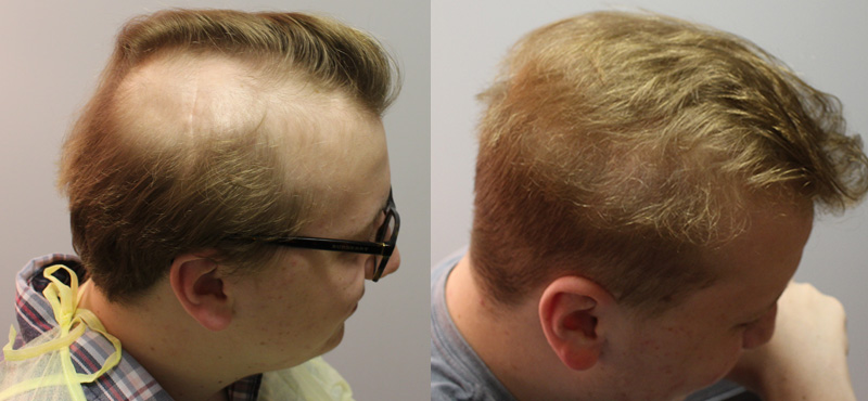 Hair Transplant Restoration For Radiation Therapy - Fallon Hair Restoration