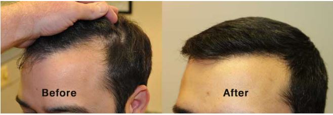 Hairline Restoration 1070 Grafts - Fallon Hair Restoration