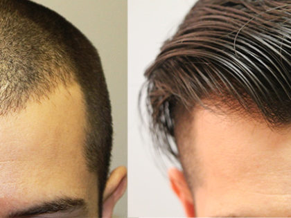 Hairline Restoration Cases