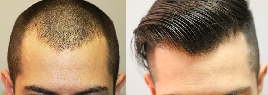 Hairline Restoration Cases - Fallon Hair Restoration