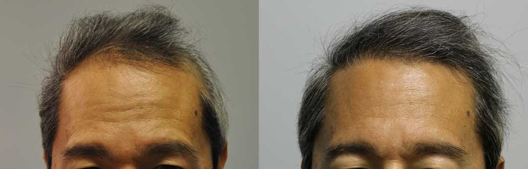 Hair Transplant Case Study - 1050 Grafts into Blue Naevus (Nevus) - Fallon  Hair Restoration