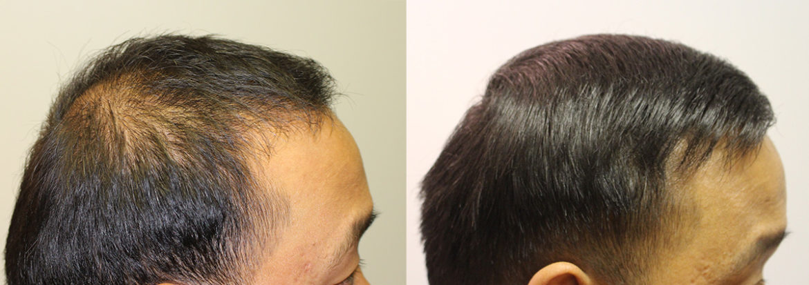 Hair Transplant Case Study - 1677 Grafts - Combination FUT and FUE ...