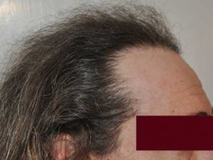 1500 Hair Grafts – 1 Session Hair Line Restoration