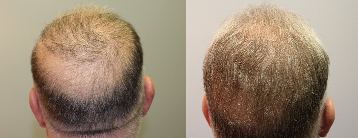 Hair Transplant Case Study - 2100 FUE Hair Grafts - Fallon Hair Restoration