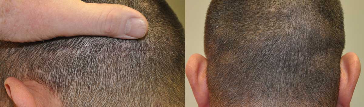 Trichophytic donor closure 4 months post op 1900 hair grafts