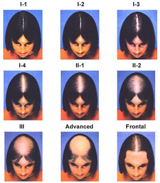 Female Hair Loss - Fallon Hair Restoration